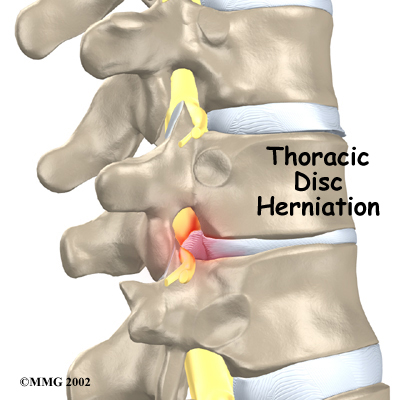 Thoracic Disc Herniation