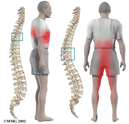 Thoracic Herniation Symptom