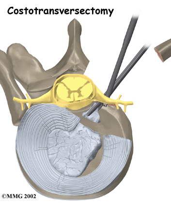 Thoracic Herniation Surgery