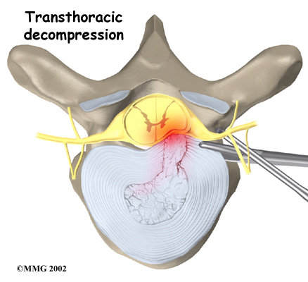 Thoracic Herniation