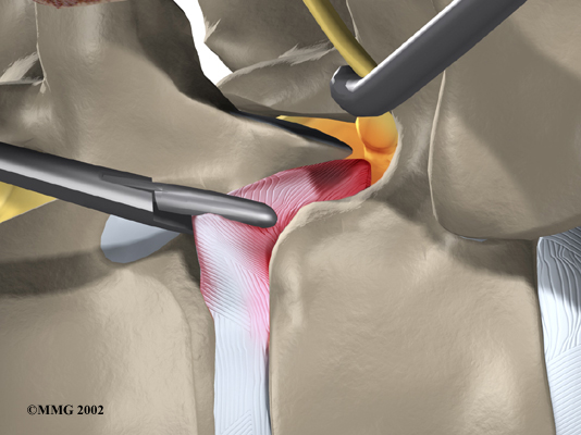 Thoracic Herniation - Cutting and Removing Damaged Portions