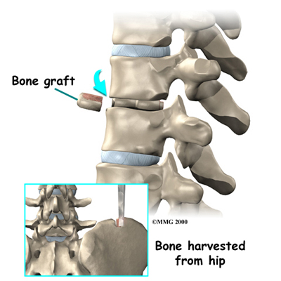 Thoracic Herniation - Fusion surgery