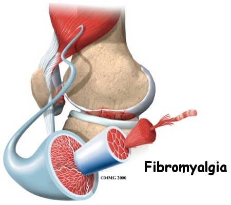 Fibromyalgia