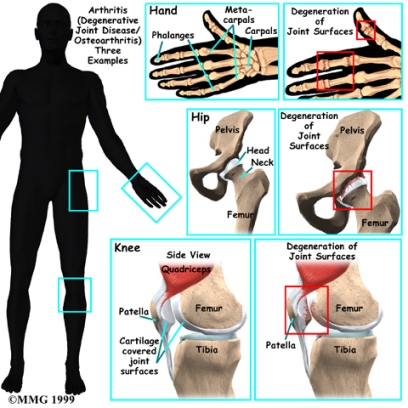 Osteoarthritis