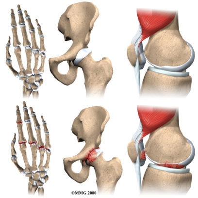 Osteoarthritis - Arthritis