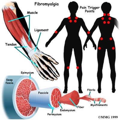 Fibromyalgia Treatment