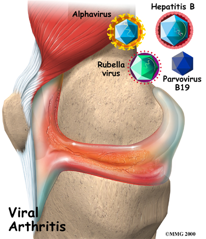 Viral Arthritis