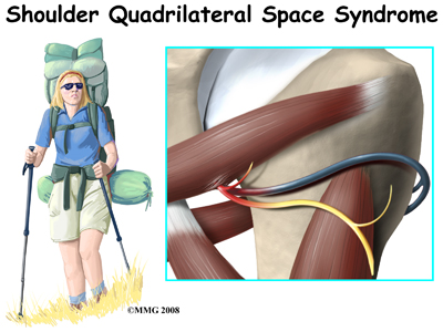 Quadrilateral Space Syndrome