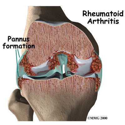 Rheumatoid Arthritis