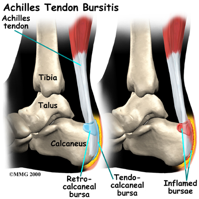 Tendocalcaneal Bursitis