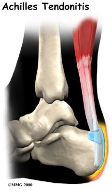 Achilles Tendonitis/Paratendonitis