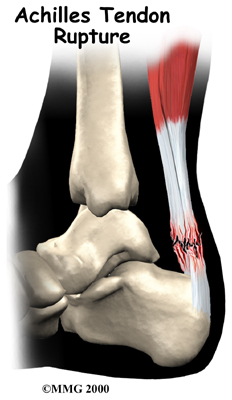 Achilles Tendon Rupture