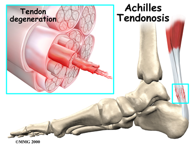 Achilles Tendon