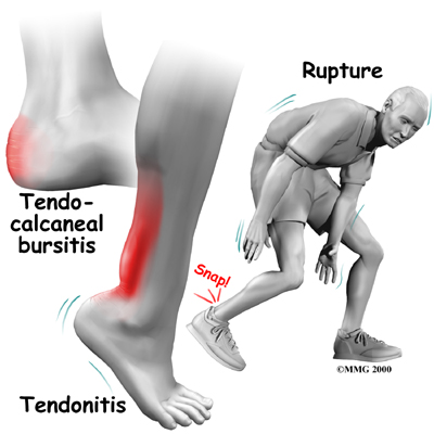 Tendocalcaneal bursitis