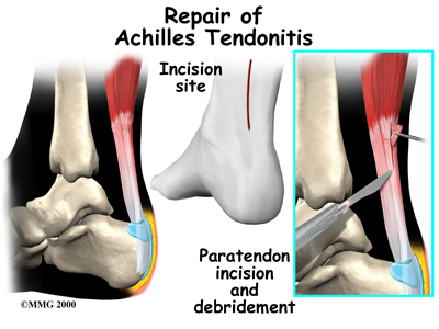 Repair of Achilles Tendonitis