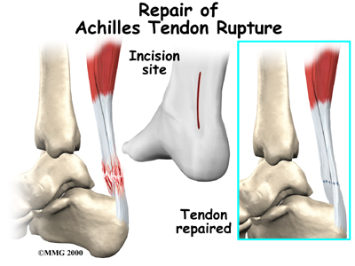 Repair of Achilles Tendon rupture