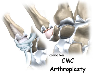 Artificial Joint Replacement of the Thumb - Emerald Hills Physio & Sports Clinic's Guide