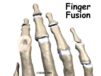 Finger Fusion Surgery - Emerald Hills Physio & Sports Clinic's Guide