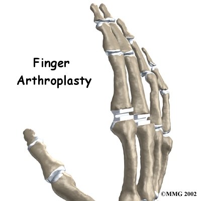 Artificial Joint Replacement of the Finger - Emerald Hills Physio & Sports Clinic's Guide