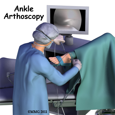 Ankle Arthroscopy