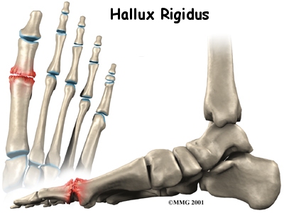 Hallux rigidus 