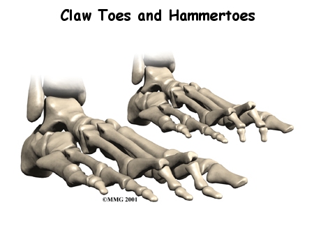 Claw Toes and Hammer Toes 